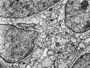 M,4y. | medulloblastoma